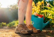 giãn tĩnh mạch có chạy bộ được không​