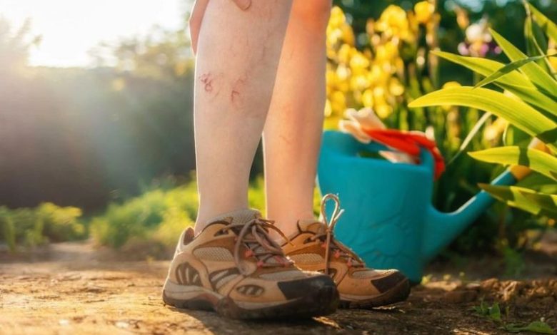 giãn tĩnh mạch có chạy bộ được không